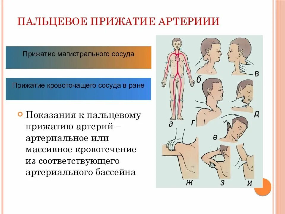 Способы остановки кровотечения пальцевое прижатие артерии. Остановка кровотечения пальцевое прижатие артерий алгоритм. Метод пальцевого прижатия артерий. Место пальцевого прижатия плечевой артерии. Пальцевое прижатие сосуда.