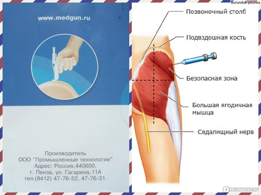 Свело икроножную мышцу и болит. После укола свело ногу. Место укола в ягодицу. После укола свело ногу. После укола свело ногу.