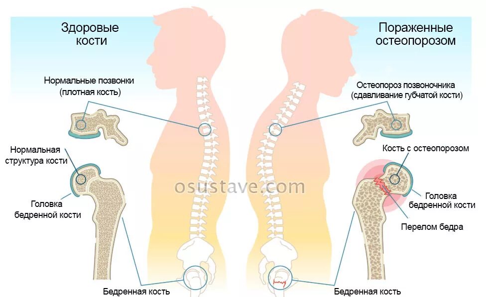 Проблемы остеопороза