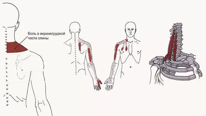 Триггерные точки поясницы. Лестничные мышцы триггерные точки. Синдром лестничной мышцы триггерные точки. Ременная мышца шеи триггерные точки. Триггерные точки передней лестничной мышцы.