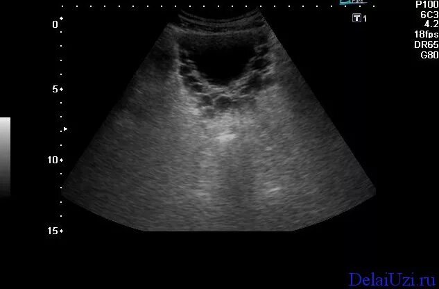 Узи полные органов. Патология мочевого пузыря на УЗИ. Отслоение стенки мочевого пузыря УЗИ. Трабекулярный мочевой пузырь на УЗИ. Конкременты мочевого пузыря на УЗИ.