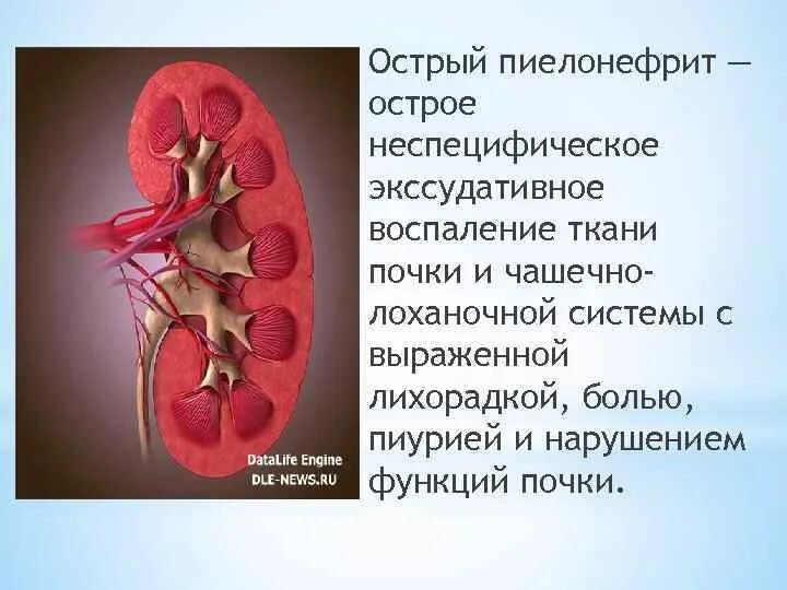 Пиелонефрит клин. Острый левосторонний пиелонефрит. Острый пиелонефрит почка. Острый осложненный пиелонефрит.