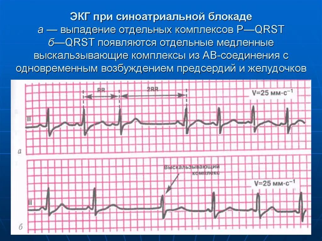 Комплекс блокада. Са блокада 2 степени на ЭКГ. Предсердная тахикардия с синоатриальной блокадой 2. Синоатриальная блокада на ЭКГ. Одиночные выскальзывающие комплексы на ЭКГ.