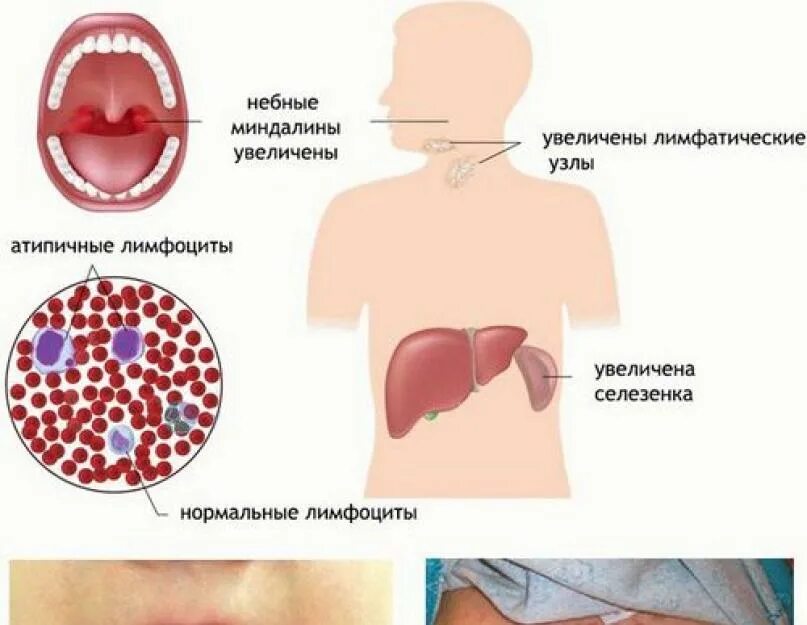 Моноклиоз. Признак проявления инфекции мононуклеоз. Вирус Эпштейна-Барр мононуклеоз. Вирусная ангина Эпштейн Барр. Инфекционный мононуклеоз (инфекция вирусом Эпштейна — Барра).