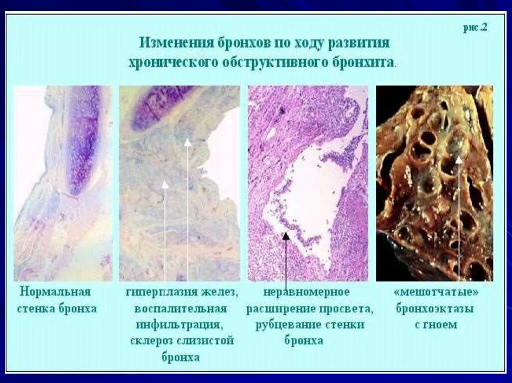 Эмфизема хронического бронхита. Хронический бронхит препарат патанатомия. Бронхит патанатомия макропрепарат. Эмфизема легкого препарат патанатомия. Легкие при ХОБЛ макропрепарат.