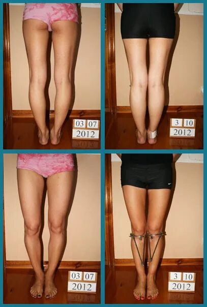 Аппарат илизарова х образные ноги. Исправление кривых. Выпрямление о образных ног. Круропластика голени асимметрия голени. Аппарат илизарова х образные ноги.