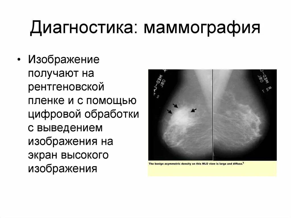 Анализ маммографии. Диагнозы маммографии молочных желез. Маммография расшифровка снимков. Норма молочной железы маммограмма. Маммография молочных желез норма у женщин таблица.