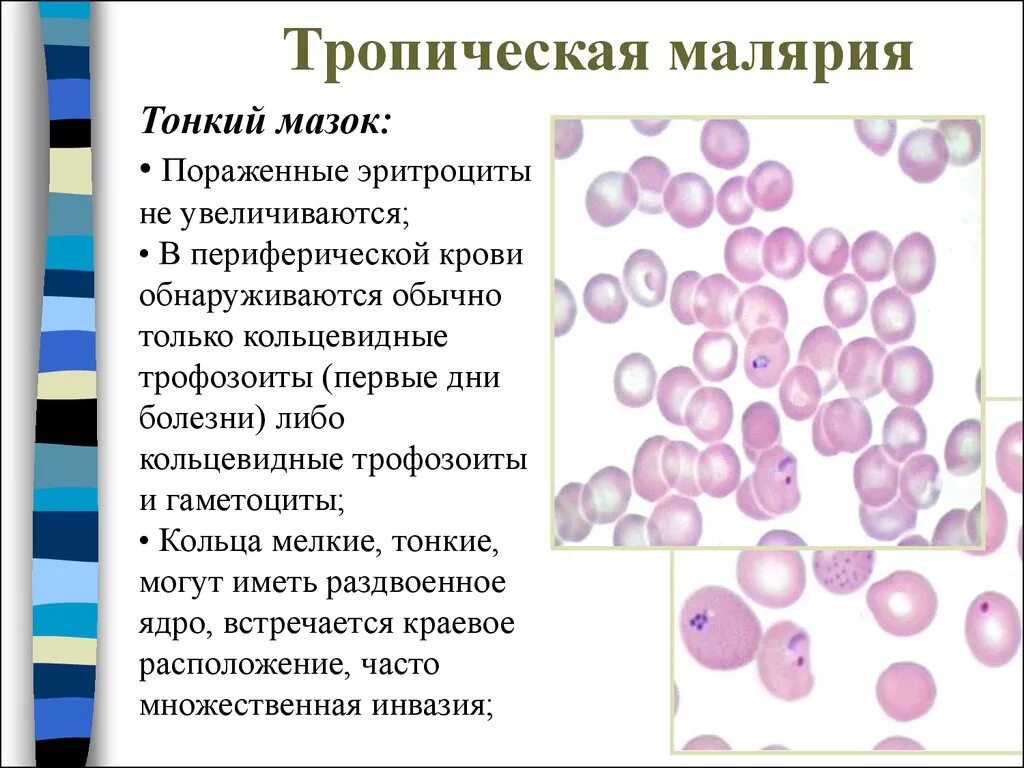 Мазок крови при выявлении патологии что это. Тонкий мазок крови при малярии. Тропическая малярия лабораторная диагностика. Эритроциты трехдневная малярия. Мазок крови больного трёхдневной малярией.