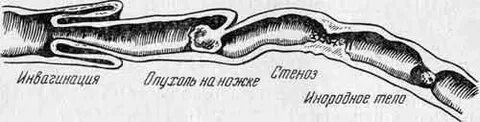 Симптом вале