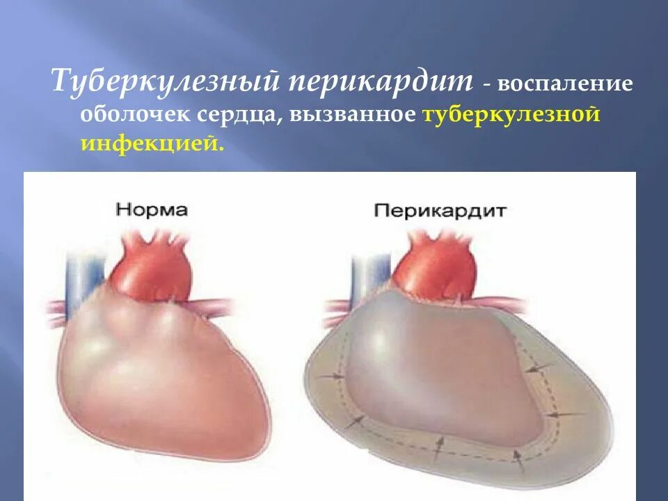 Скопление воздуха и крови в перикарде. Экссудативный туберкулезный перикардит. Туберкулезный перикардит.