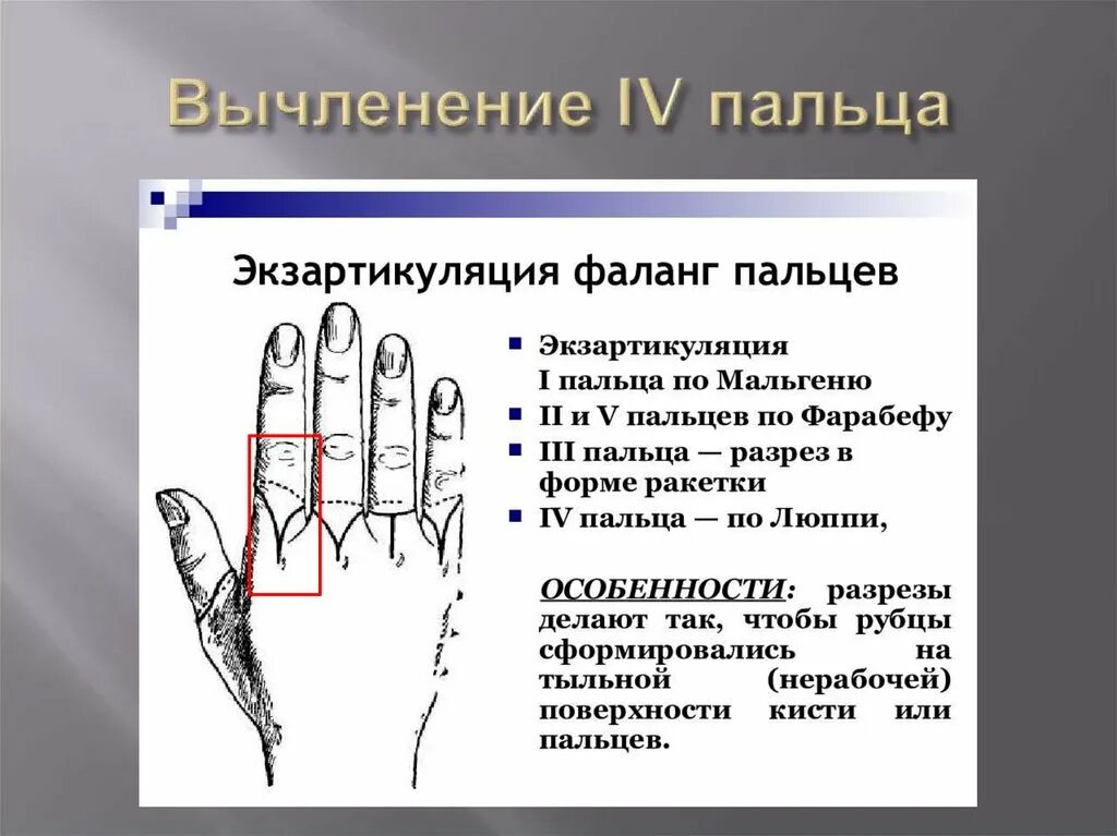Экзартикуляция фаланг пальцев. Схема ампутации фаланг кисти. Экзартикуляция конечности. Экзартикуляция пальцев кисти, ампутация ногтевой фаланги. Экзартикуляция ii и v пальцев по фарабефу.