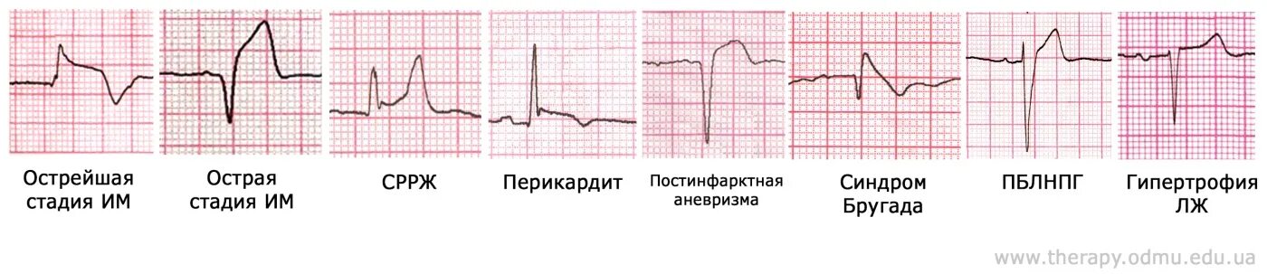 Депрессия сегмента st. Депрессия и элевация сегмента St. Элевация ст на ЭКГ. Смещение сегмента St на ЭКГ. Косовосходящая депрессия St на ЭКГ.