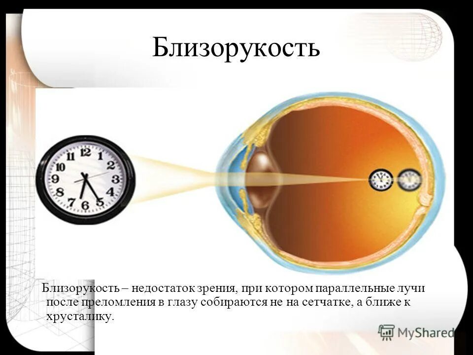 Дефекты зрения ответы. Дефекты зрения. Зрение дефекты зрения. Оптическая система глаза дефекты зрения. Глаз как оптическая система зрение.