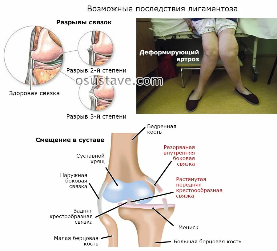 Дегенерация мениска. Лигаментоза связок сустава. Крестообразная связка колена. Порваны связки коленного сустава. Лигаментит коленного сустава.