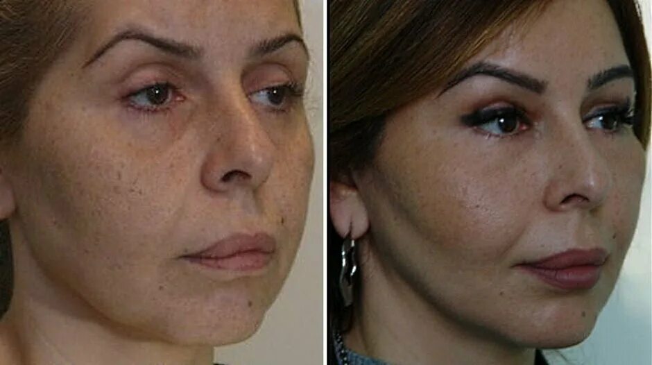 Липофилинг эффект. Липофилинг эффект. Липофилинг лица. Липофилинг век жолтиков. Липофилинг вокруг глаз.