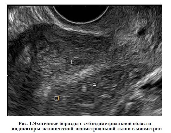 Эхо аденомиоза. Эндометриома УЗИ картина. Диффузно Узловой аденомиоз УЗИ матки. Диффузный эндометриоз матки УЗИ.