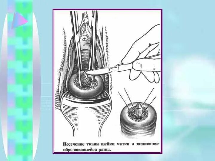 Иссечение шейки матки. Методы обследования шейки матки. раны методы обследования.
