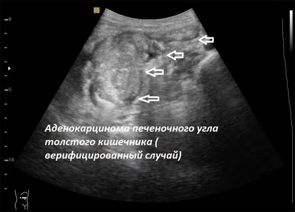 Кишечные новообразования УЗИ. УЗИ кишечника (эндоректальная ультрасонография). Новообразование кишечника на УЗИ. Узи кишечника как подготовиться