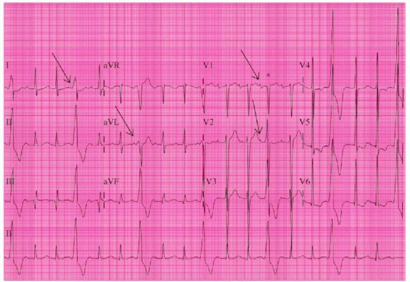 Широкий комплекс qrs