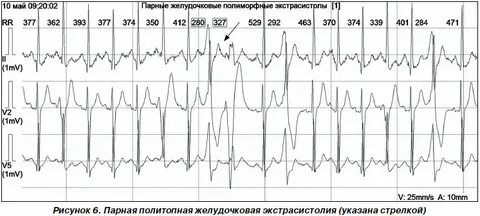 Полиморфные экстрасистолы