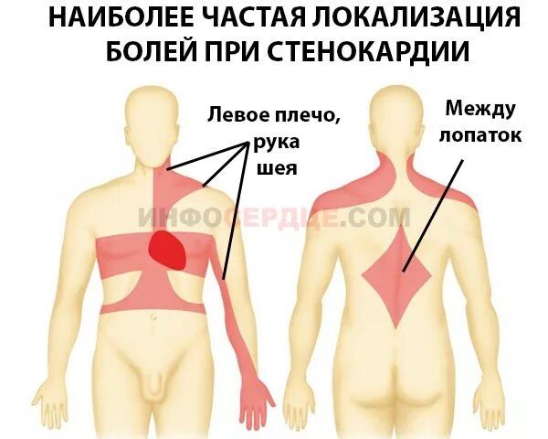 Боли при болезни легких. Локализация стенокардии. Стенокардия локализация боли. Локализация сердечных болей.