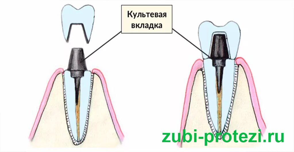 Литые культевые штифтовые вкладки. Штифтовая культевая вкладка. Разборная культевая вкладка. Культевая вкладка на 24 зуба.