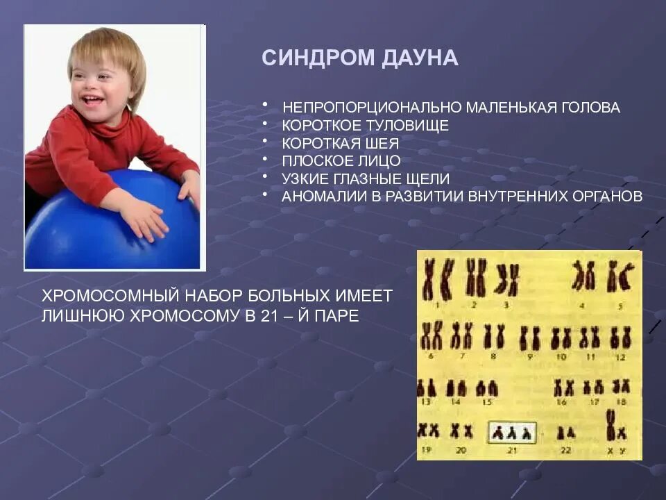 Синдром дауна является примером. Синдром дауна тип наследования. синдром дауна это наследственное заболевание. синдром дауна презентация. болезнь дауна презентация.