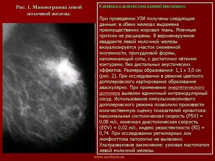 Объемного образования левой молочной железы