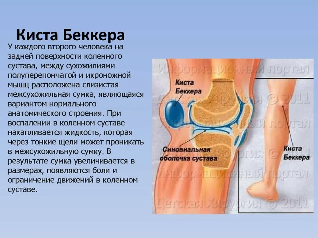 Киста Беккера в коленном суставе. Строение сустава. Киста Беккера анатомия.
