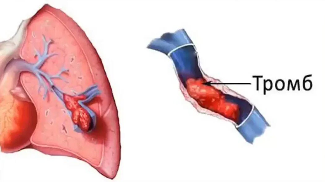 Тромб в легочной артерии. Тромбэктомия легочной артерии. Эмболия тромбом легочной артерии. Тромбоз артерия и вена