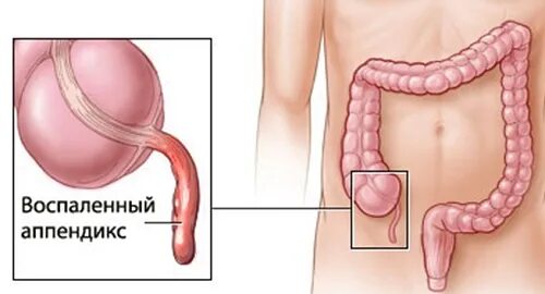 Острые боли при аппендиците. Где находится аппендицит. Локализация аппендицита. Периодически болит аппендицит. Острый аппендицит памятка для пациентов.