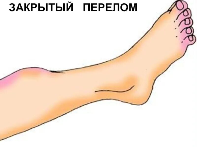 Закрытый перелом это. Закрытый перелом костей ноги. закрытый перелом рисунок. открытый перелом конечностей.