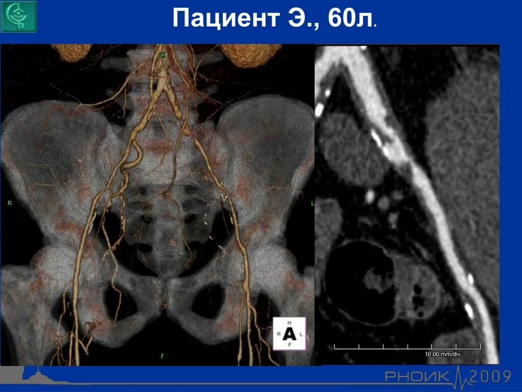 Кт органов таза у мужчин. Кт ангиография малого таза. Позвоночная артерия МСКТ. Кт-ангиография артерий нижних конечностей.