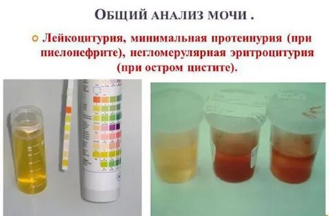 Почему появляются лейкоциты в моче у женщин: какие болезни могут быть? Отвечает 