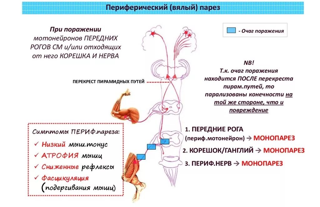 Двигательные симптомы поражения. Нижний парапарез патогенез. Периферический дистальный парапарез. Периферический парез нижних конечностей. Центральный рефлекторный тетрапарез.