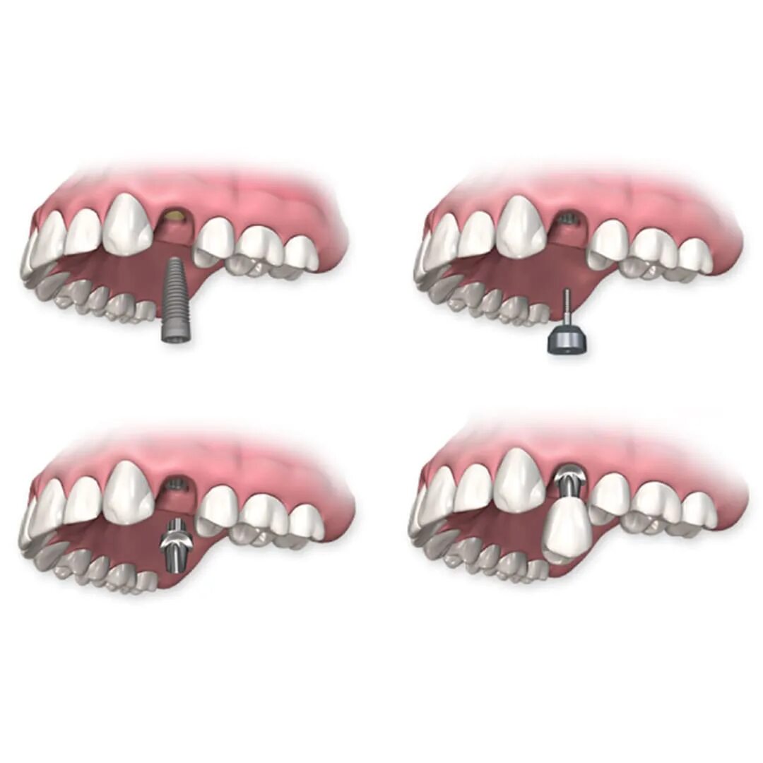 Зубы импланты поэтапно. Формирователь десны Implantium. Двухэтапная имплантация зубов этапы. Этапы дентальной имплантации. Формирователь десны на имплант что такое.