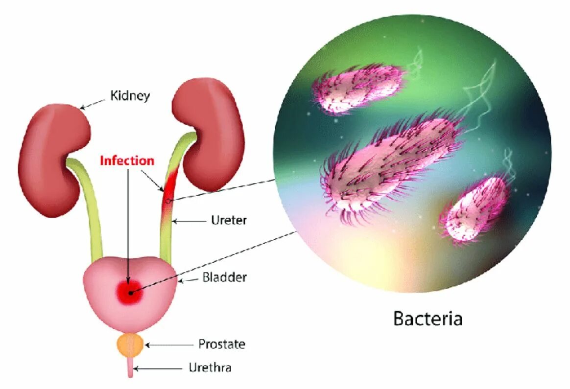 Кишечная палочка в мочевом пузыре. Кишечная палочка в мочевом пузыре у женщин. Инфекционное воспаление мочевого пузыря. Уретра у мужчин инфекция