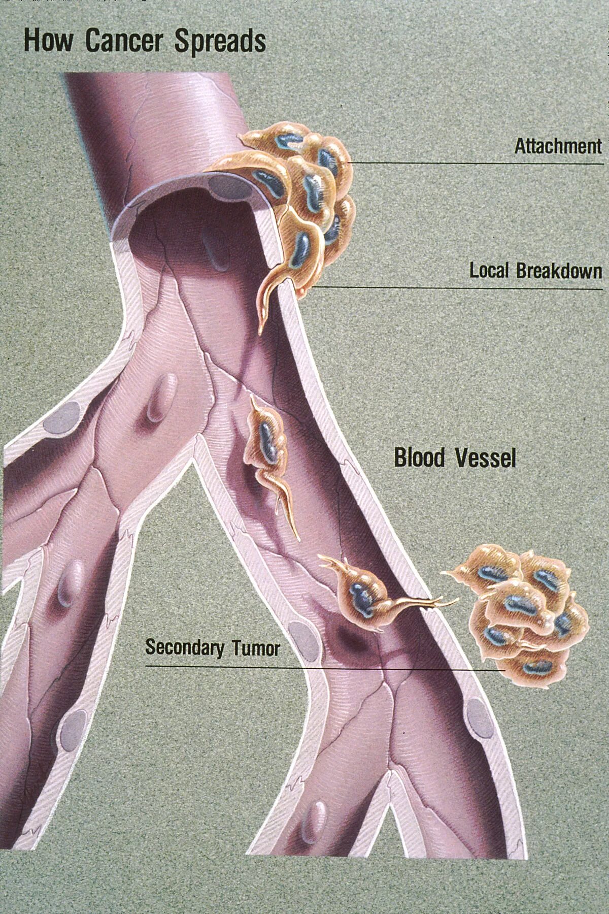 Metastasis