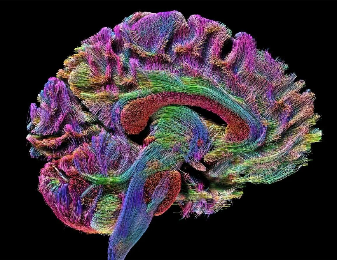 Магнитно резонансная трактография. Трактография мрт. МР трактография головного. Диффузионно тензорная трактография. Диффузный характер головного мозга