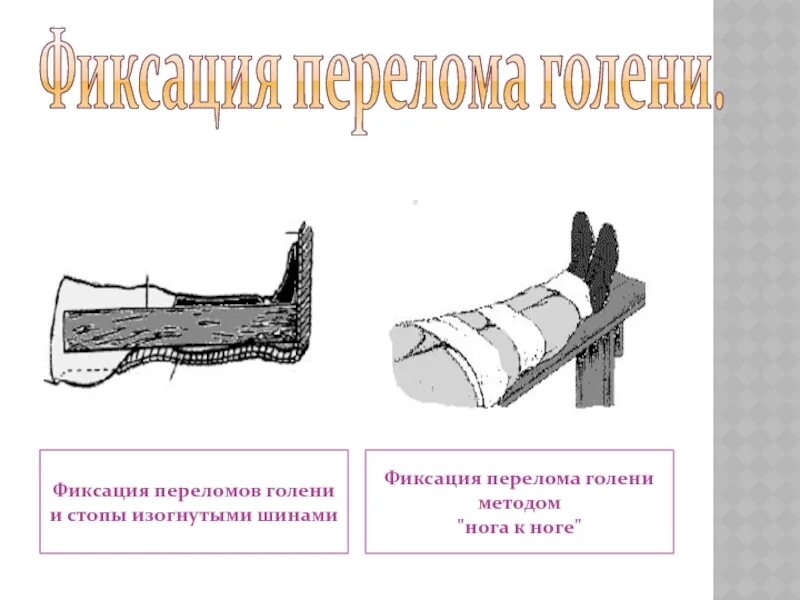 Кровотечение при открытом переломе голени. Перелом стопы фиксация. Фиксация конечностей при переломах.