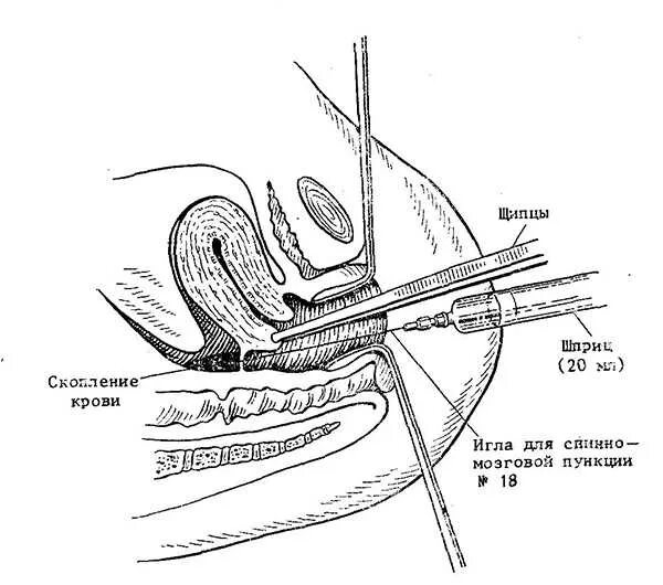 Пункция заднего свода влагалища (кульдоцентез). Пункция заднего свода инструменты. Пункция заднего свода методика. Пункция прямокишечно-маточного углубления. Влагалищные своды