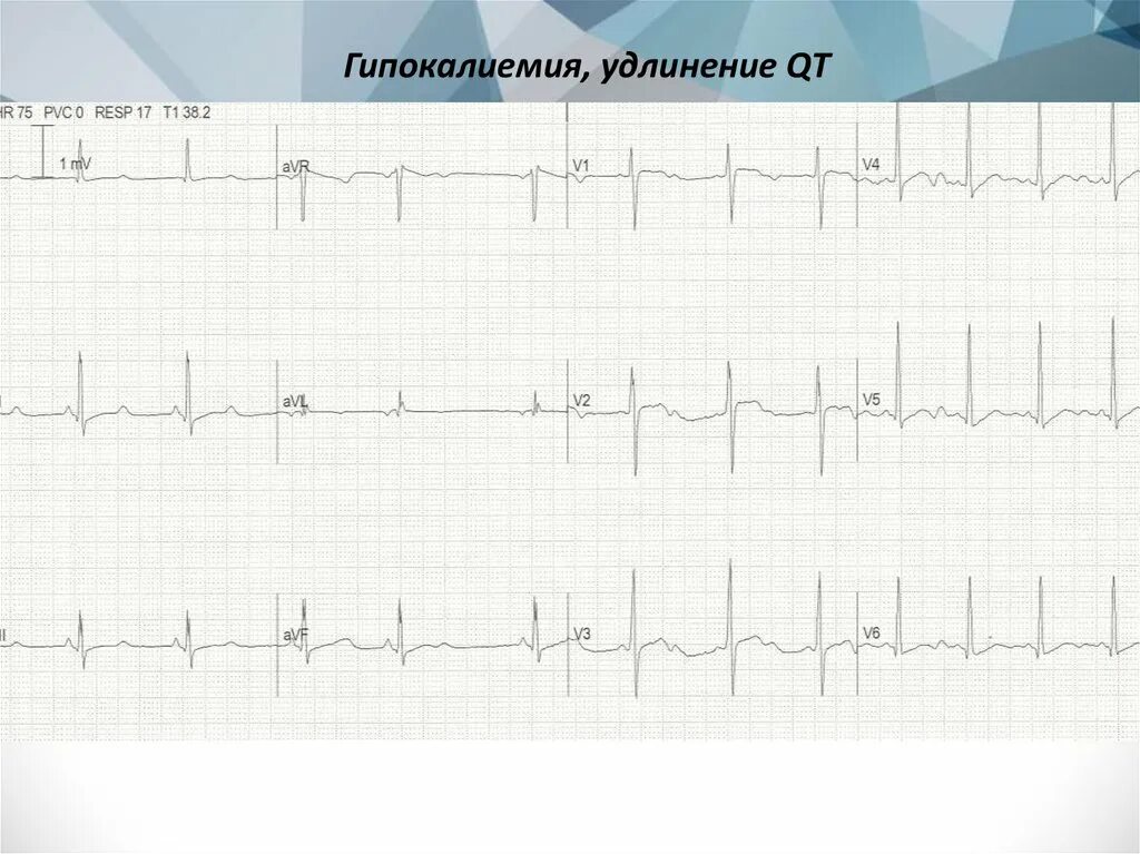 Удлиненное qt на экг. ЭКГ при гипокалиемии. Признаки гипокалиемии на ЭКГ. ЭКГ при гипомагниемии. Гипомагниемия на ЭКГ признаки.