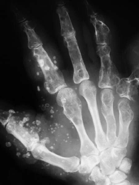 нарост на кости большого пальца ноги. узлы гебердена рентген. перелом фаланги мизинца рентген. костного нароста рук. остеосаркома кисти рентген.