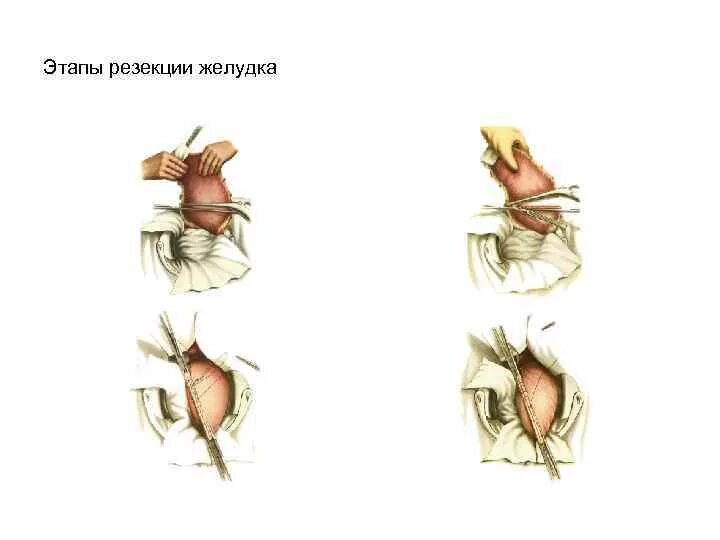 Этапы после операции. Резекция желудка Бильрот 1 этапы. Дистальная резекция желудка операция. Резекция желудка этапы операции. Дистальная резекция желудка этапы операции.