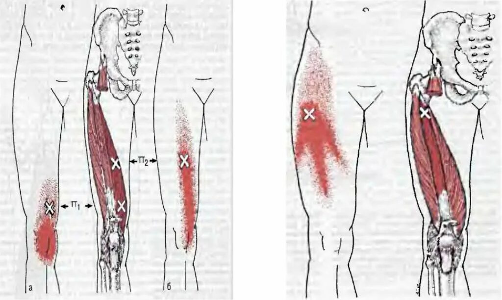Прямая мышца бедра триггерные точки. Триггерные точки мышц бедра. Миофасциальный синдром малой ягодичной мышцы. Триггерные точки ягодичной мышцы.