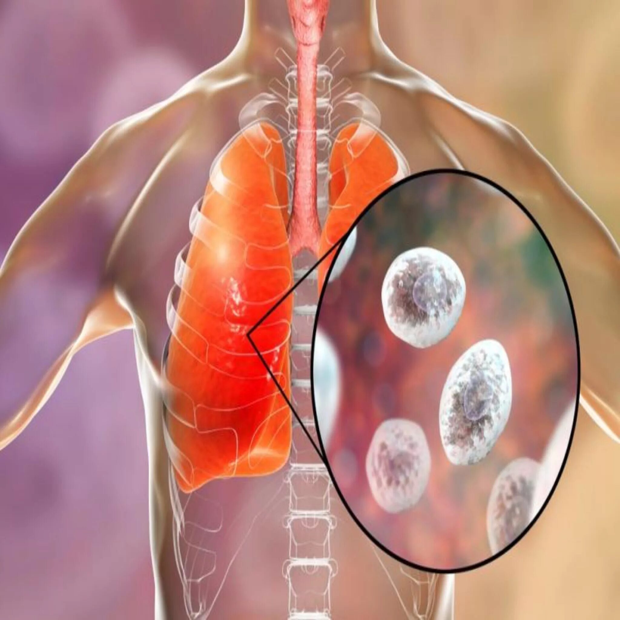 Инфекция с мокротой. Грибок Pneumocystis jirovecii.