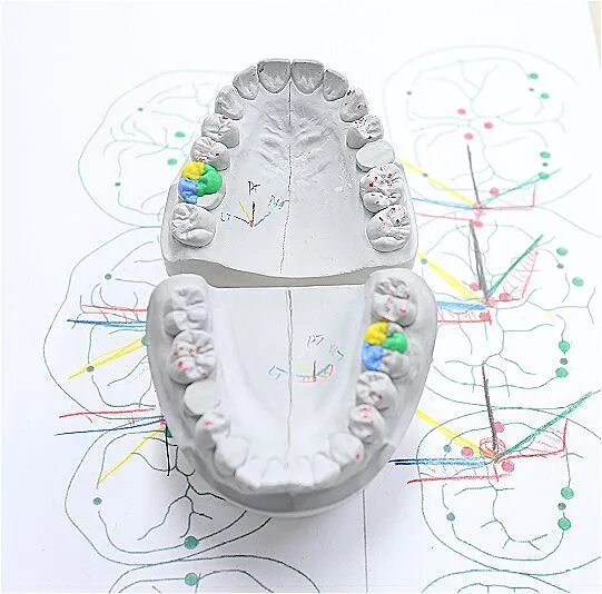 Компас зуба. Окклюзионный компас. Окклюзионный компас жевательных зубов. Окклюзионный компас в стоматологии. Окклюзионный компас в стоматологии по Шульцу.