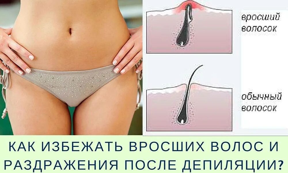 Удаление вросших волос. Типы вросших волос плакат. Как предотвратить врастание. Типы вросших волос плакат. Спиралевидное врастание волос.