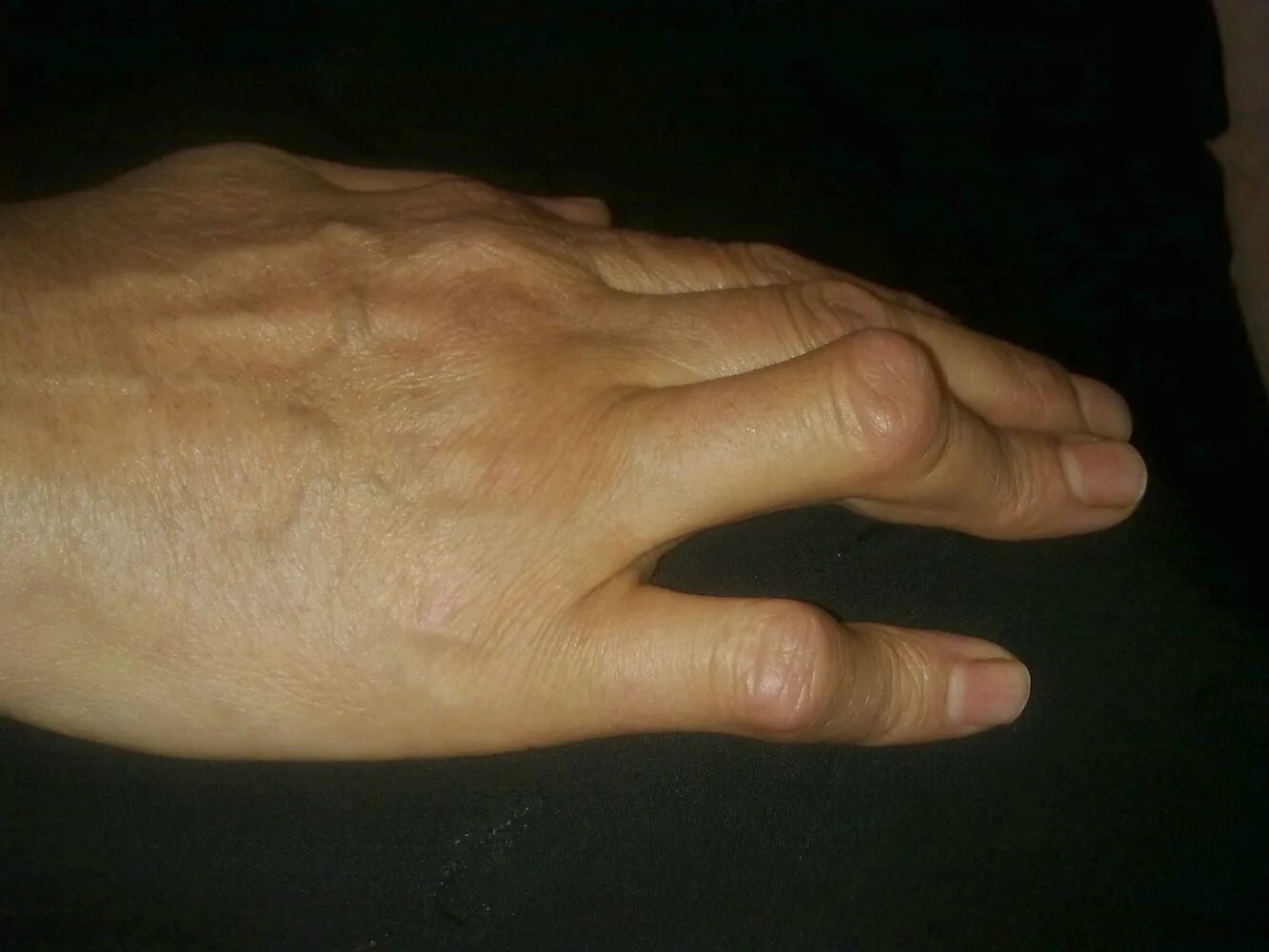 Как появились руки. Ладонный фиброматоз Дюпюитрена. Шишки на суставах пальцев рук.