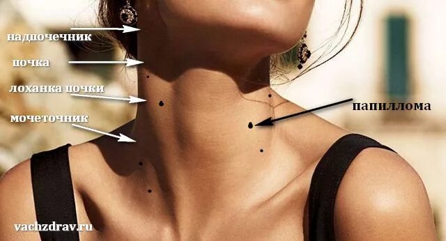 Морщины на шее кольца венеры. Ожерелье венеры сифилитическая лейкодерма. На шее появились у женщин. Мраморная сифилитическая лейкодерма. На шее появились у женщин.